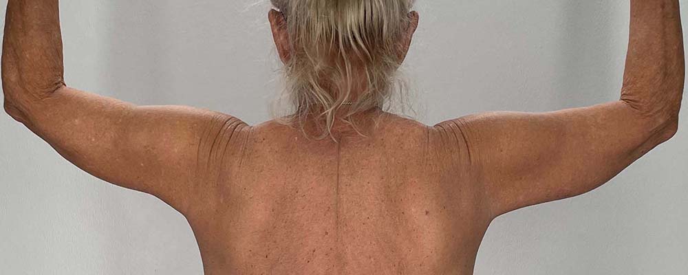 Arm Lift Before & After Image